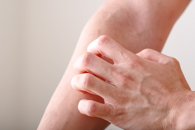 かきむしり跡を目立たなくする市販薬・ケア商品は？おすすめ12選を紹介！【薬剤師解説】