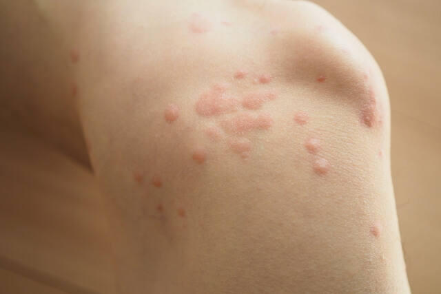 じんましんを体質から改善！症状別おすすめと選び方を紹介！使用時の注意点やポイントも【薬剤師解説】