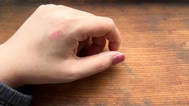 やけどを冷やしても痛いときは？応急処置と市販薬の選び方を紹介！｜皮膚炎症状別の対処法とおすすめ市販薬12選【薬剤師解説】