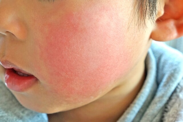 りんご病の発疹・かゆみはどう対処？市販薬と受診の目安【薬剤師解説】