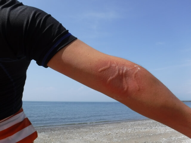 クラゲ刺され後に使える市販薬の選び方