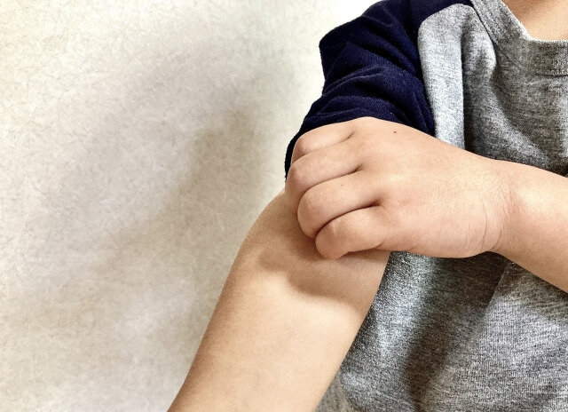 子どもの乾燥肌でかきむしりが止まらない..市販薬の選び方とおすすめ【薬剤師解説】