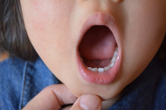 子どもの口内炎におすすめの市販薬9選！｜原因別の選び方も解説【薬剤師解説】