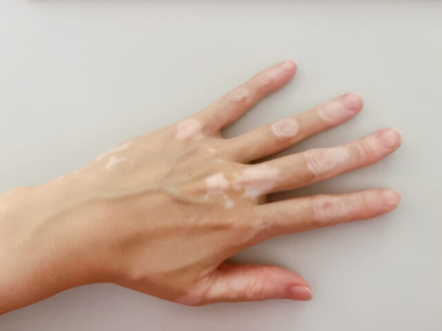 白斑にステロイド市販薬は使える？｜使っていい症状・ダメな症状や白斑と湿疹の違い【薬剤師解説】