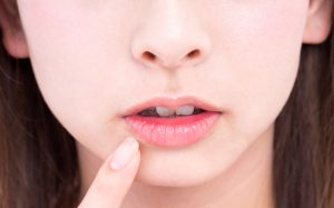 【口の中に白い苔のようなもの？】口腔カンジダ症の症状・治療について解説