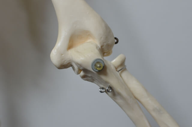 【両側】骨折・脱臼