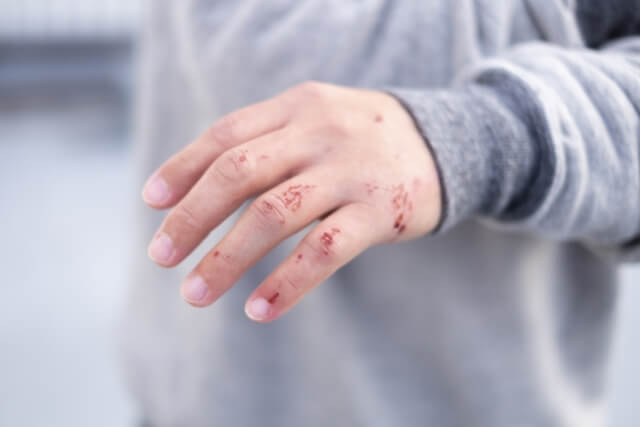 【症状別】化膿に効果的な塗り薬抗生物質の選び方