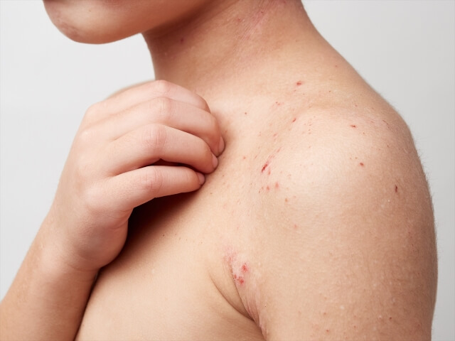 【医師が解説】アトピー性皮膚炎とは？  皮膚症状の特徴を年齢別に紹介