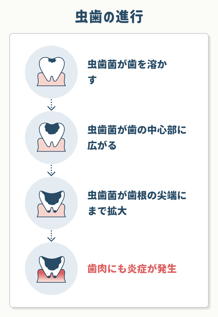 原因②：虫歯が進行したもの