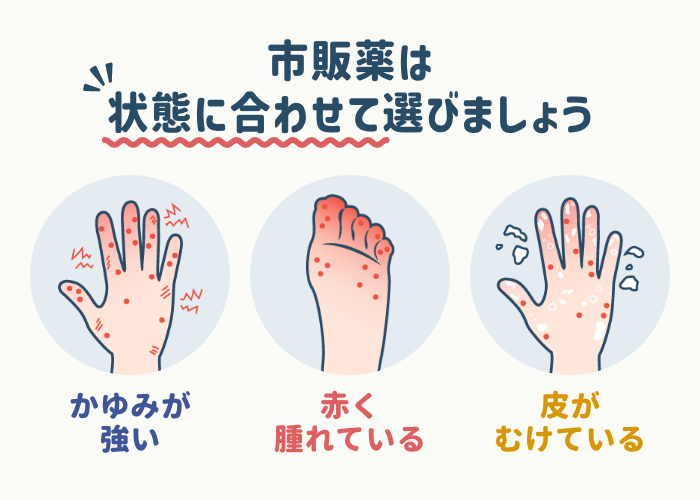 汗疱に効果のある市販薬の選び方